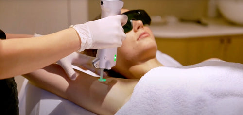 douleur epilation laser