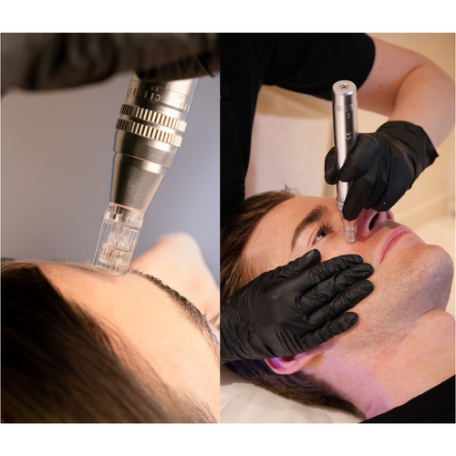 Une femme et un homme reçoivent un traitement de microneedling dans un centre de médecine esthétique.