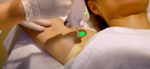 epilation laser resultat