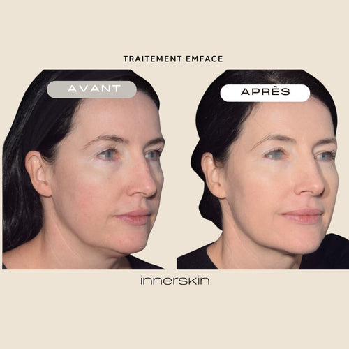 Traiter le double menton sans chirurgie : solutions efficaces