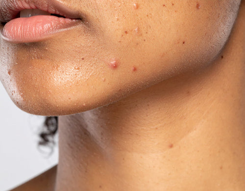 Acné hormonale : causes, solutions et traitements efficaces