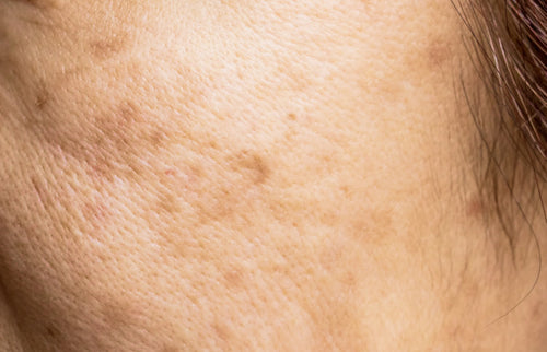 Taches pigmentaires après l’été : le protocole Innerskin Babyface + Rétinol pour une peau nette