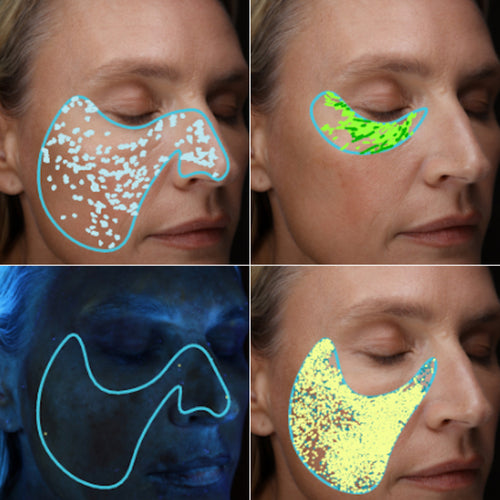 Skinfusion® treatment at Innerskin